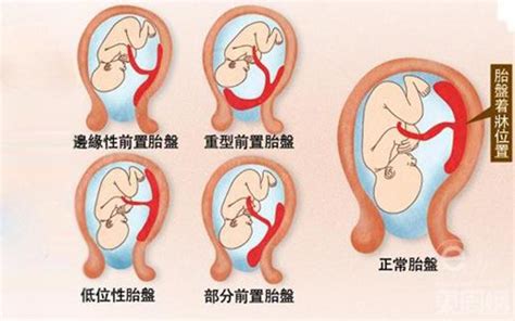 胎盤母體面|胎盤:結構,功能,成熟度,藥用價值,常見胎盤異常,